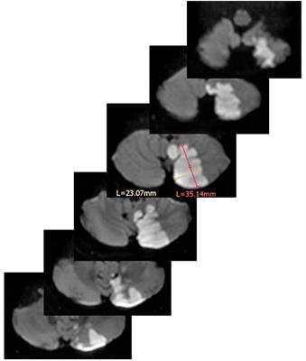 Automated Supra- and Infratentorial Brain Infarct Volume Estimation on Diffusion Weighted Imaging Using the RAPID Software